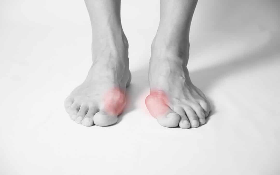 A Better Way to Do Bunion Surgery