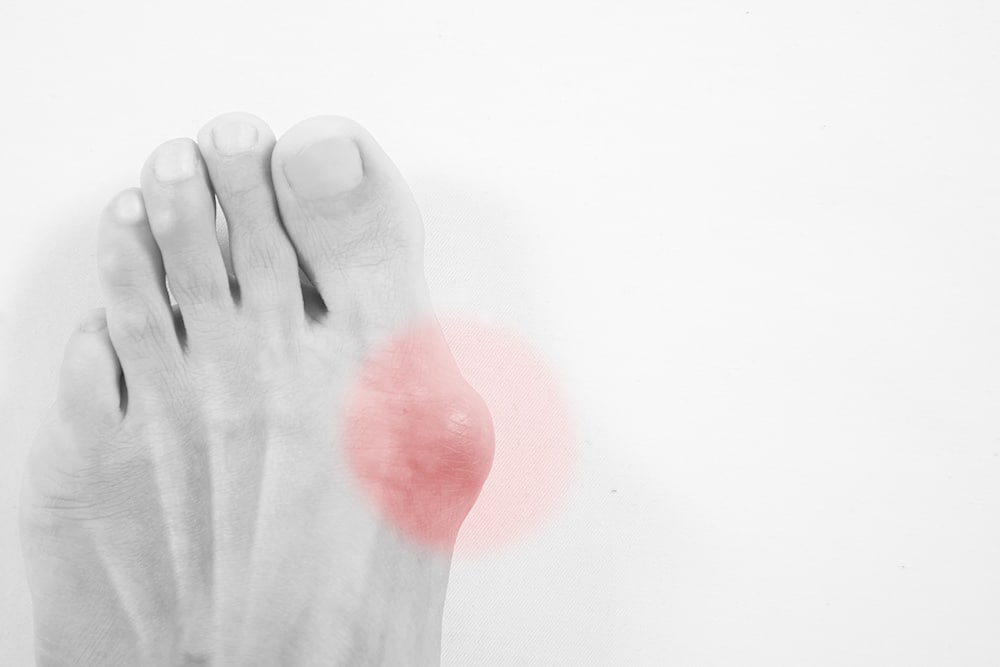 Everyday Tips for Managing Bunion Pain